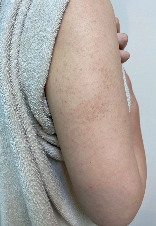 二の腕のブツブツ 毛孔性苔癬 のこと アピアランスビューティクリニック